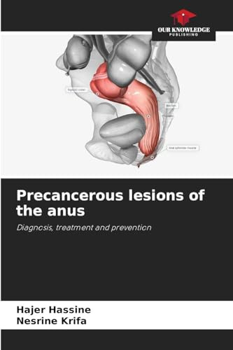 Precancerous lesions of the anus: Diagnosis, treatment and prevention
