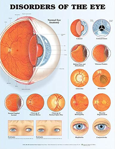 Anatomical Chart Disorders of the Eye Anatomical Chart Wandbild Wandmontage Klassenzimmer