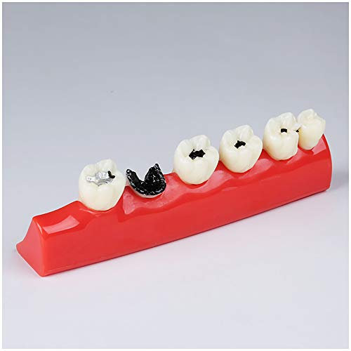 Teeth model, Caries Developing Model - Study Model - Simulation Oral Tooth Model for Model,