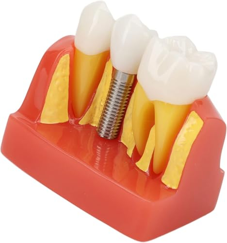 UIGJIOG Zahnimplantat-Modell Kieferorthopädische Behandlung Kunstharzmodell Zahnimplantat-Modell Die Patientenaufklärung,Kronen-Brückenmodell Aufklärung Kommunikation Mit Patienten Laboratorium