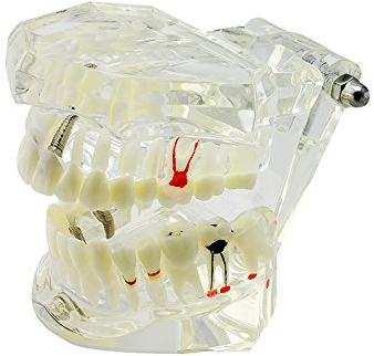 Denshine Dental Implant Krankheit Zähne Modell mit Restoration & Bridge Tooth