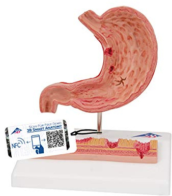 3B Scientific® Magenmodell – Humananatomie-Modell mit Geschwüren und pathologischen Veränderungen, Langlebiges PVC + Smart Anatomy App (5 Jahre Garantie)