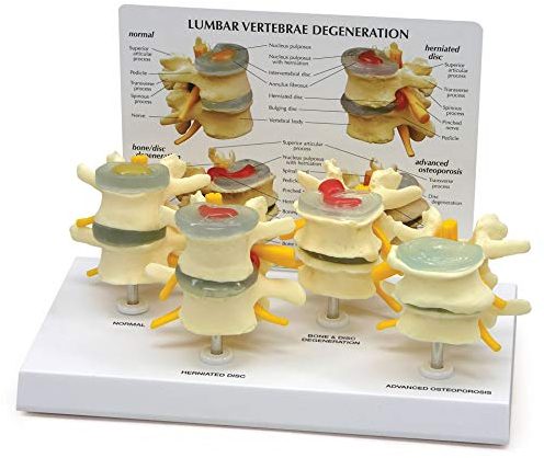 GPI Anatomicals Anatomie-Replik von 4-stufigen Wirbelproblemen für Ärzte, Büros, pädagogisches Werkzeug