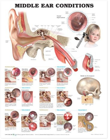Middle Ear Conditions Anatomical Chart