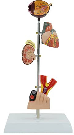 Pathologisches Modell Von Diabetes Mellitus Anzeigemodell Für Diabeteskomplikationen Anzeigemodell Für Pathologische Bluthochdruckläsionen