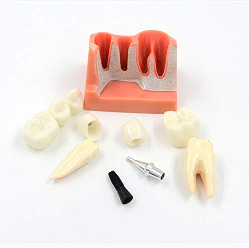 Zahnimplantat-Modell, Zähne Implantatanalyse Kronenbrücke Demonstration Zahnmodell Mit Abnehmbaren Kronen, Für Bildung, Patientenkommunikation