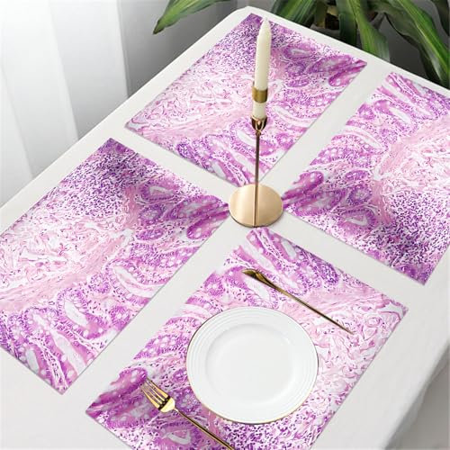 UREJD Tischsets Abwaschbar 4 Set,Vinyl Platzsets Abwaschbar für küche Speisetisch Hotel,Kaffeehaus,Festsaal,Platz-Matten,Mikroskopische Ansicht eines Ductus-Zell-Karzinoms, Adenokarzinom aus,30x45cm