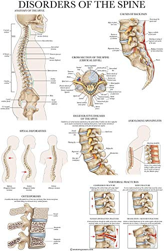 Palace Learning Poster Disorders of the Spine Anatomy – laminierte Wirbelsäulenerkrankungen, anatomisches Diagramm – 45,7 x 61 cm