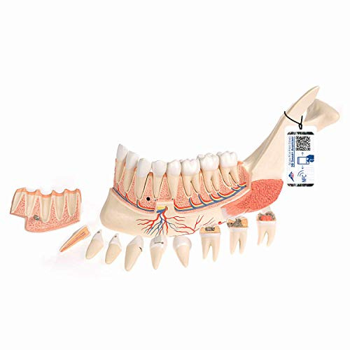3B Scientific® Unterkiefermodell – Halber Unterkiefer mit 8 kariösen Zähnen, 19-teiliges Humananatomie-Zahnmodell + Smart Anatomy App (5 Jahre Garantie)