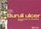 Buruli Ulcer: Prevention of Disability Pod