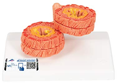 3B Scientific Menschliche Anatomie - COPD Modell + kostenlose Anatomie App - 3B Smart Anatomy