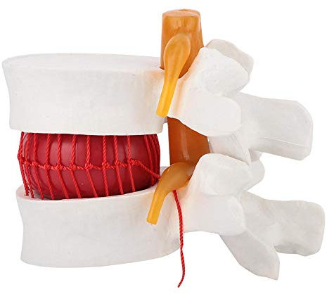 LiebeWH Plastisches menschliches Bandscheibenvorfall Medizinisches Demonstrationsmodell, 1: 1,5 Modell des Modells der menschlichen Bandscheibe der Lendenwirbelsäule für den linearen Unterricht