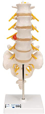 3B Scientific® Lendenwirbelsäulenmodell – Lebensgroße Lendenwirbel mit dorsolateralem Bandscheibenvorfall-Demonstration + Smart Anatomy App (5 Jahre Garantie)