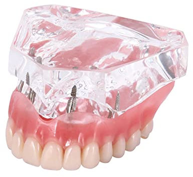 Modèle de prothèse dentaire, modèle de démonstration dentaire des dents, modèle d'implant dentaire de restauration de prothèse dentaire avec implants supérieurs