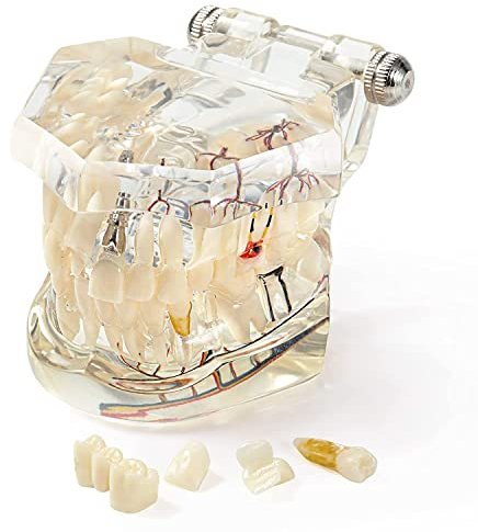 UIGJIOG Zähnemodell Neural Reparatur Zahnmodell Implantat Krankheit Zahnarzt Standard Pathologischer Abnehmbar