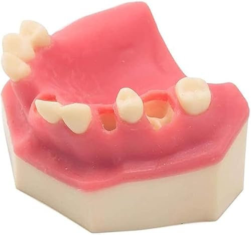 NBGPPDW Zahnmodell Studienmodell Anatomiemodell Zahnimplantat Praxiszahnmodell Unterkiefer Typodont mit Gingiva Overdenture Oberkieferzähne 4 Implantate Demo
