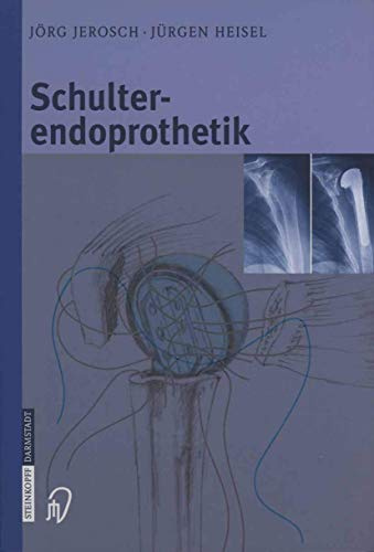 Schulterendoprothetik. Indikation, Implantate, OP-Technik, Nachbehandlung, Begutachtung
