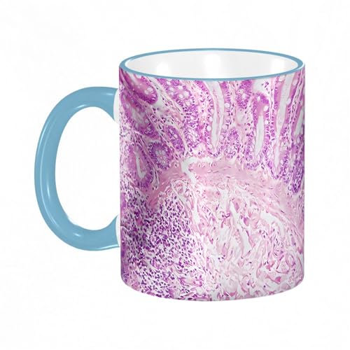 YOIUE Tasse aus Keramik - Große 11oz Tassen 330ml Kaffeetassen mit Henkel, 100% Handbemalt - Trinkgläser mit Griff - Weiß,Mikroskopische Ansicht eines Ductus-Zell-Karzinoms, Adenokarzinom aus einem m