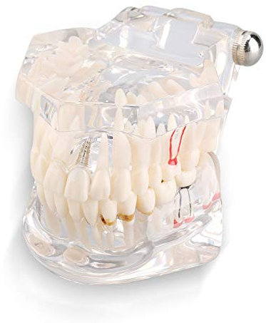Zahnmodell - Dental Teaching Study Adult Demonstration, Demonstratives Implantatmodell und festsitzender Zahnersatz auf dem Implantat