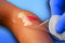 Neoheal sterile Hydrogel-Wundauflage 12x24cm, 5 Stück/Pack