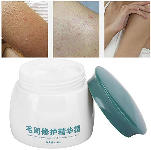 Keratosis Pilaris Cream, Keratosis Pilaris Treatment, Chicken Skin Smoothing Cream, Body Soothing Chicken Skin Treatment Body Care Cream for Rough Bumpy Skin, 50g/1.8 oz