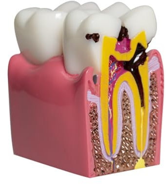 BURLOE Zahnanatomie Modell, Aus Harz Für Die Mundpflege Im Dentallabor Zahn Karies Vergleich Studienmodelle Zahnarzt Aufklärungszahnmodell,Rosa