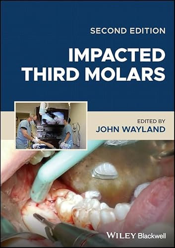 Impacted Third Molars (English Edition)