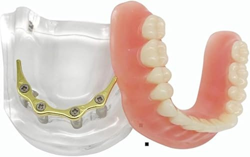 ZWDCVFGK Dental-Mundimplantat-Modell, Unterkieferzähne, 4-Nagel-Implantat, Arzt-Patient-Kommunikations-Display-Modell