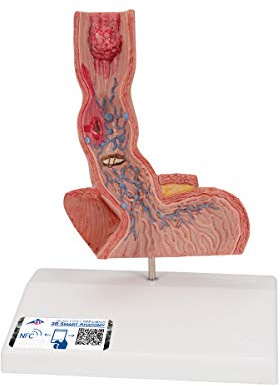 3B Scientific Menschliche Anatomie - Erkrankungen der Speiseröhre + kostenlose Anatomie App - 3B Smart Anatomy