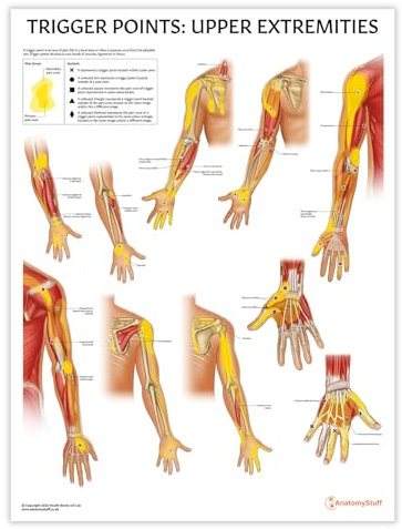 Anatomy Stuff Poster mit Triggerpunkten: obere Extremitäten, 45 x 60 cm, Physiotherapie-Lernwerkzeug, Schmerzzonen-Diagramm
