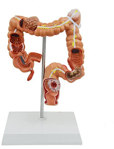 UIGJIOG Anatomisches Modell der Dickdarm Medizin des menschlichen Gloen -Darmmodells des Dickdarmpathologie -Modellmodells des Unterrichts anatomischer Mensch