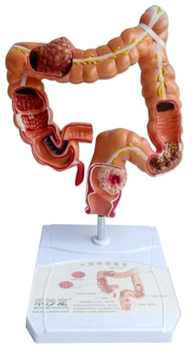 Asyduey Teaching Model,Human Large Intestine Anatomy Model Visceral Lesion Model Human Digestive System Learning Model Easy to Use