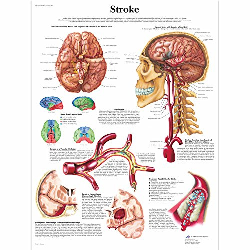 3B Scientific Lehrtafel Schlaganfall, Anatomieposter Zerebrovaskulärer Insult, Lehrtafel Hirndurchblutung und Schlaganfall-Pathologie