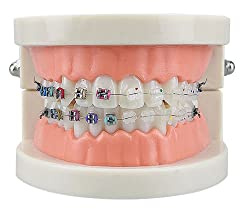 Standard Orthodontic Teeth Model, YOUYA DENTAL Demonstration Orthodontic Model Teeth Teach Study Tools with Metal and Ceramic Bracket(Red)