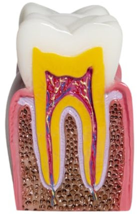 TTETTZ 6 Veces El Modelo de Diente de Caries para La Educación en El Aula Y Explicación de Los Estudiantes