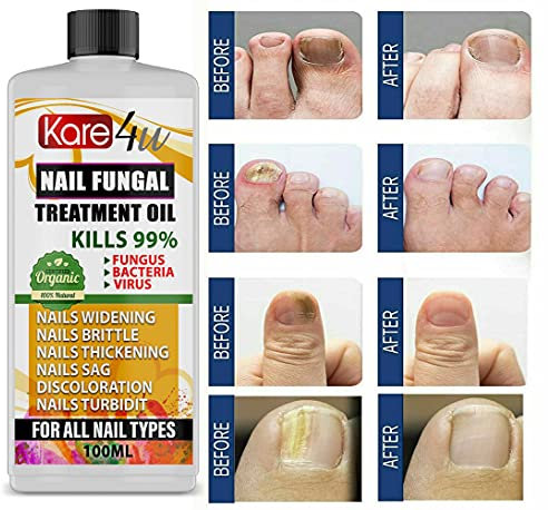 Anti Fungal Treatment Fungus Effective Finger Toe Nail Repair Liquid Solution UK (100ML CAP)