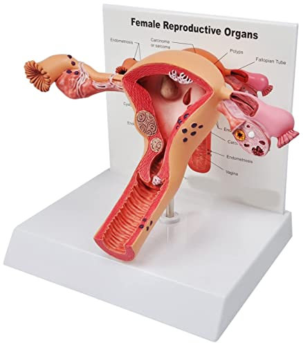 UIGJIOG Human Uterus Model Sick Uterus Modell Uterus-Eierstock Modell Weibliche Reproduktion der Organe Anatomisches Modell