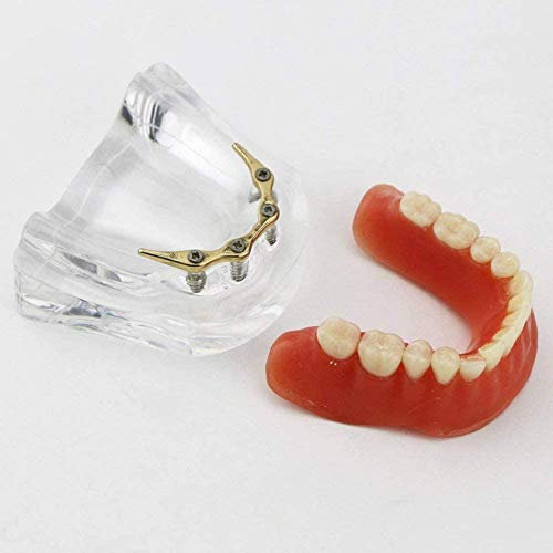 LBYLYH Restauración De Modelo con 4 Implantes Dentales, Implantes De Precisión De Demostración Inferior Modelo De Los Dientes Prótesis Dental, Restauración Protésica Decoración