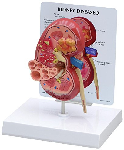 GPI Anatomicals 3260 Niere Modell normal mit Erkrankung