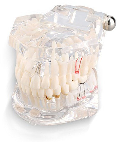 Yosoo transparent Erwachsenen Pathologien Dental Implant Zahnarzt Parodontalerkrankungen Demonstration ASSORT Zähne Zahnfleisch Zahnpflege Unterricht Studio Standardmodell Typodont - Abnehmbarer