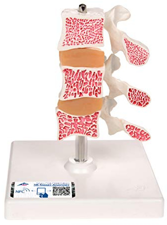 3B Scientific Menschliche Anatomie - Osteoporose Modell mit 3 Lendenwirbeln, auf Stativ + kostenlose Anatomie App - 3B Smart Anatomy, Luxusmodell