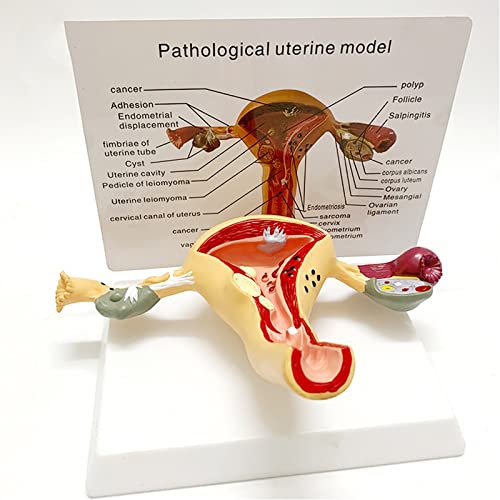 Uterus & Eierstock Pathologisches Modell Human Uterus Modell, krankes Uterus-Modell for Ärzte Büro Pädagogisches Werkzeug
