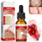 Ingrown Toenail Treatment Drop,Nail Growth Ingrowing Toenail Treatment,Cuticle Care Oils for Ingrown Toenails,Nail Growth Treatment,Ingrowing Toe Nail Treatment,Toe Nail Fungus Treatment Cuticle Oil
