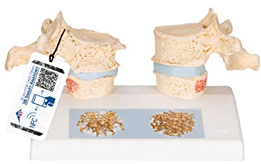 3B Scientific Menschliche Anatomie - Osteoporosemodell + kostenlose Anatomie App - 3B Smart Anatomy