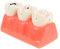 ULTECHNOVO 1 Pc Modèle De Pathologique Modèle De Dents D'adulte Étude De Modèle De Dents D'implant Support Métallique Enseigner Étudiant Bloc