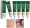 Crema Antimicotica A Base Di Erbe Per Mani, Crema A Base Di Erbe Per Eliminare Il Fungo Del Piede, Crema Per Funghi Dell'unghia Del Piede, Crema Per La Cura Della Pelle Dei Funghi (5Pcs)
