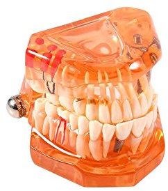 Zähne Herausnehmbar Zahnmodell Zahnprotesen Demonstration Zähne Modell für Studie Lehren (Orange)