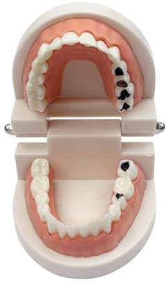 Decay Tooth Model, YOUYA Dental Caries Standard Teeth Teaching Model Study Tool Adult Disease Standard Typodont Demonstration Teeth Model for Kids Oral Care Teaching