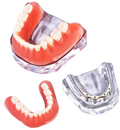 UIGJIOG Demonstration Zahnmodell Zahnmedizinische Prothese Zähne Overdenture Modell Präzision Demo Unterricht Kinderkrankheiten Modell, Neue Anpflanzung Und Restaurierung Modelle 4 Nägel