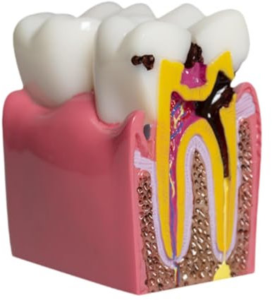 harayaa 6 Veces La Herramienta de Aprendizaje de Enseñanza del Modelo de Dientes de Caries para Maestros de Demostración